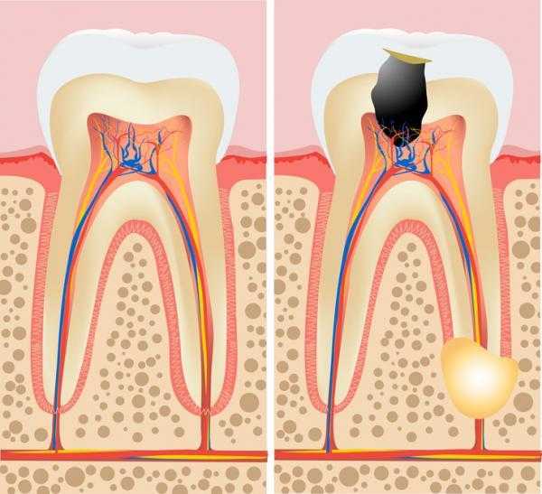 Cura Ascesso E Fistola Dentale Dental Center Snc